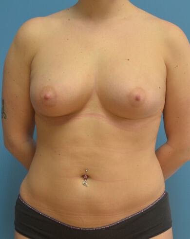 Fat Transfer Augmentation Before & After Image