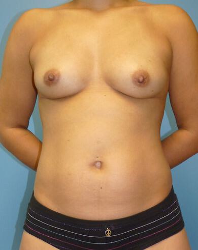Fat Transfer Augmentation Before & After Image