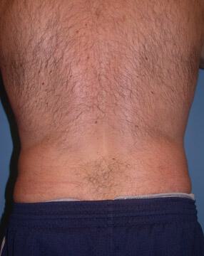 Liposuction for Men Before & After Image